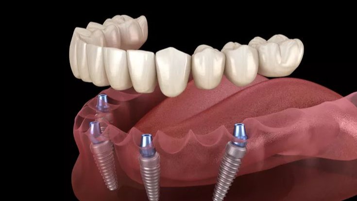 implant dentist in punawale, implant dentist pune, dental implants punawale, dental implant specialist pune, missing teeth replacement pune, tooth implant clinic punawale, affordable dental implants pune, best implant dentist punawale, permanent tooth replacement pune, DR Hileri Mori
