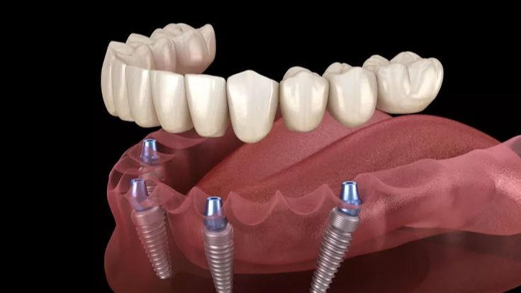 fixed teeth solution, fixed teeth solution Pune, best fixed teeth solution Pune, permanent fixed teeth solution, dental implants Pune, full mouth dental implants, missing teeth replacement Pune, smile restoration Pune, implant dentist Pune, DR Hileri Mori