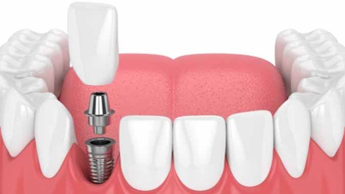 dental implants in punawale, dental implants pune, best dental implants in punawale, implant dentist punawale, dental implant clinic pune, affordable dental implants punawale, tooth replacement punawale, dental implants near punawale, permanent dental implants pune, DR Hileri Mori