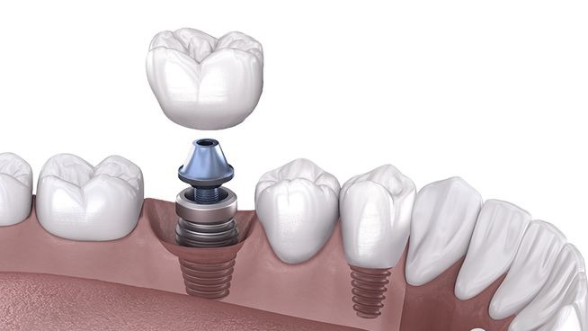 Tooth Replacement in Punawale, Tooth Replacement Pune, Missing Tooth Replacement Punawale, Best Tooth Replacement in Punawale, Tooth Replacement Clinic Pune, DR Hileri Mori, Dental Tooth Replacement Pune, Tooth Implant Punawale, Smile Restoration Pune, Tooth Replacement Treatment Punawale