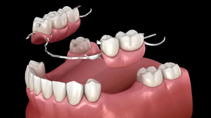Fixed Teeth Solution in Pune, Fixed Teeth Solution Pune, Best Fixed Teeth Solution Pune, Fixed Teeth Treatment Pune, Fixed Teeth Replacement Pune, Fixed Teeth Clinic Pune, Tooth Replacement Pune, Fixed Dental Teeth Pune, Missing Teeth Solution Pune, DR Hileri Mori Pune