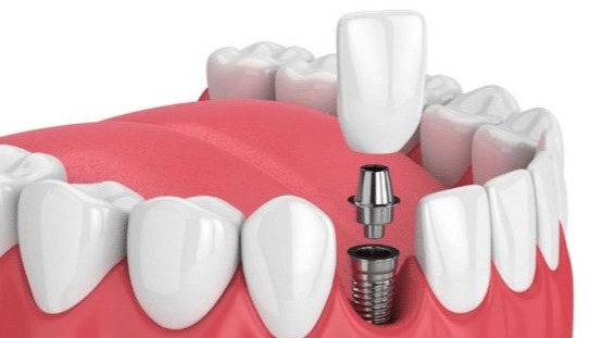 Dental Implants in Punawale, Dr Hileri Mori, Pune, Best Dental Implants in Punawale, Dental Implant Clinic Pune, Tooth Implant Pune, Implant Dentist Pune, Missing Teeth Replacement Pune, Full Mouth Dental Implants Pune, Single Tooth Implant Pune