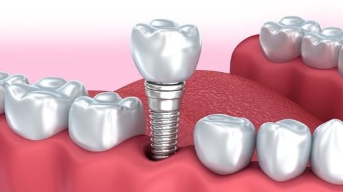 Implants for Missing Teeth, Implants for Missing Teeth Pune, Dental Implants Pune, Missing Teeth Replacement Pune, Dental Implants for Missing Teeth, Tooth Replacement Pune, Best Dental Implants Pune, Missing Teeth Treatment Pune, Dental Implant Treatment Pune, DR Hileri Mori Dental Implants