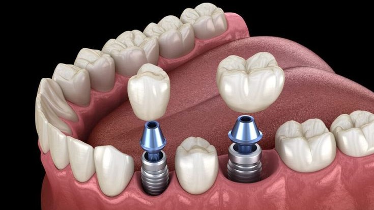 Bite Correction Treatment in Pune, Bite Correction Dentist Pune, Bite Correction Specialist Pune, Dental Bite Correction Pune, Bite Alignment Treatment Pune, Bite Correction Dentist, Bite Correction Treatment, Dental Bite Alignment, Best Bite Correction Treatment Pune, Dr. Hileri Mori Bite Correction