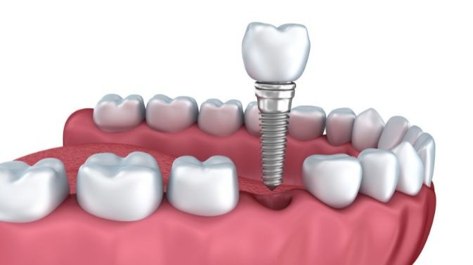 single tooth implant cost Pune, single tooth implant Pune, single tooth dental implant cost Pune, tooth implant cost Pune, dental implant cost Pune, single tooth replacement Pune, dental implants Pune, tooth replacement cost Pune, implant dentist Pune, Dr. Hileri Mori